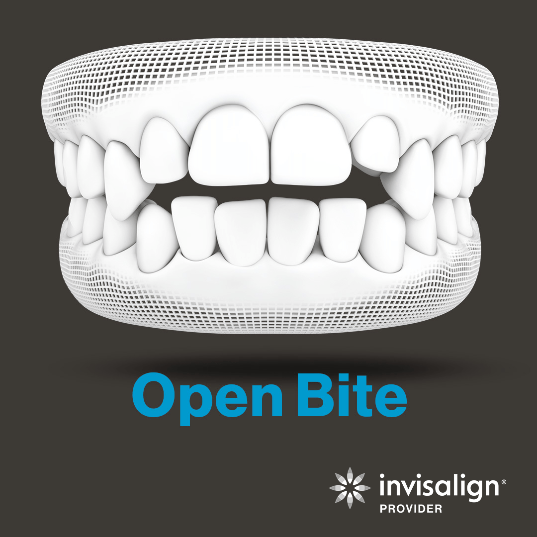 Invisalign® - Central Park Dentistry of Osage, Iowa