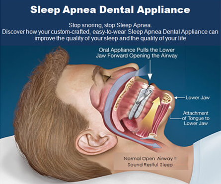 Sleep Apnea appliance